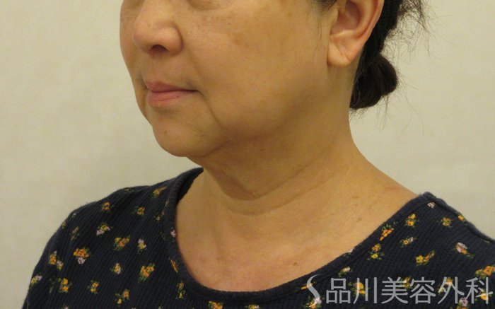 症例NO.73982のBEFORE写真
