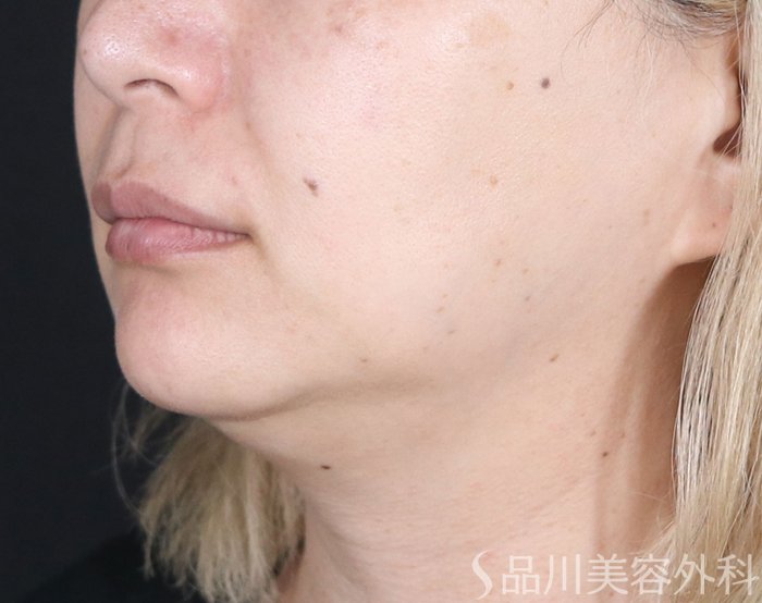 症例NO.73267のAFTER写真