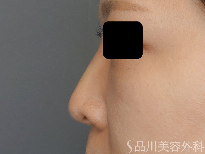 症例NO.71822のAFTER写真