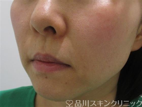 症例NO.35171のBEFORE写真