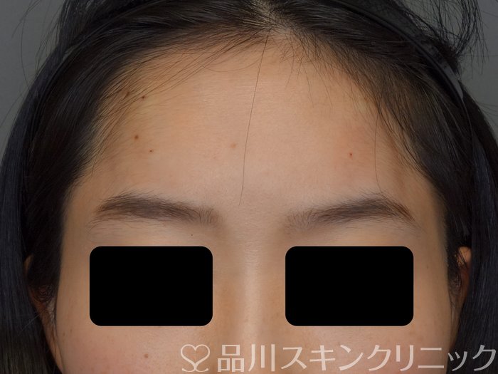 症例NO.74090のAFTER写真