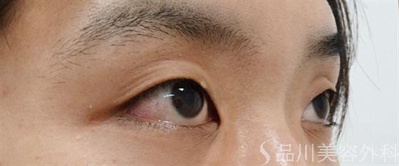 症例NO.50930のBEFORE写真