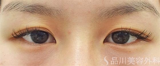 症例NO.34443のBEFORE写真