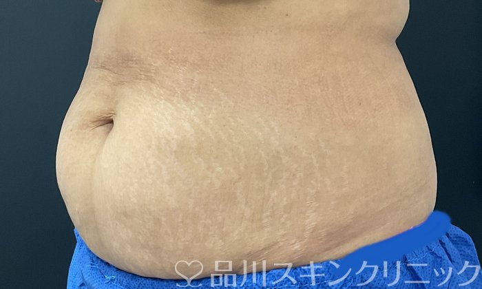 症例NO.74680のBEFORE写真