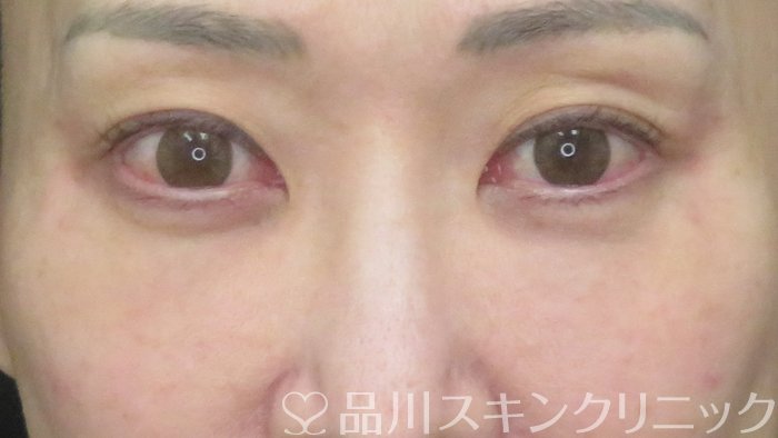 症例NO.72171のAFTER写真