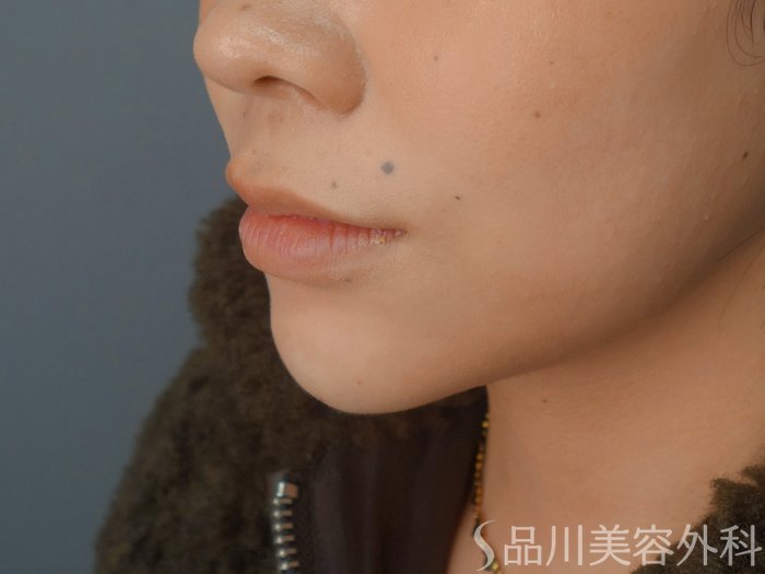 症例NO.72470のAFTER写真