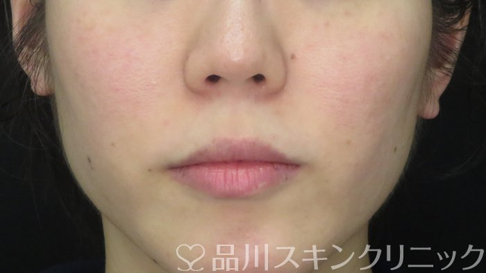 症例NO.70774のAFTER写真