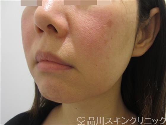 症例NO.44896のBEFORE写真