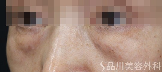 症例NO.69625のBEFORE写真