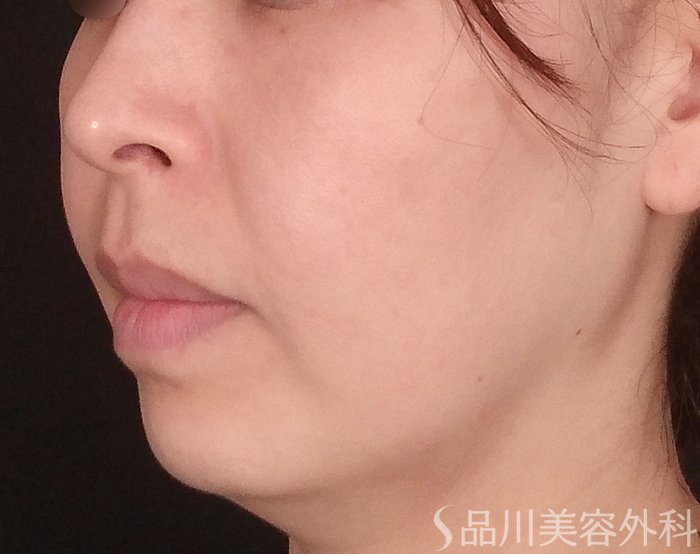 症例NO.69794のBEFORE写真