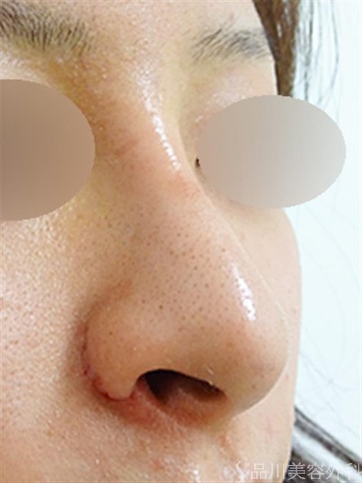 症例NO.33348のAFTER写真
