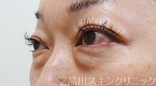症例NO.62928のBEFORE写真