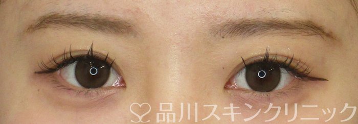 症例NO.64887のBEFORE写真