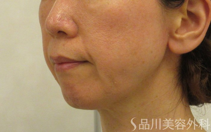 症例NO.73148のBEFORE写真