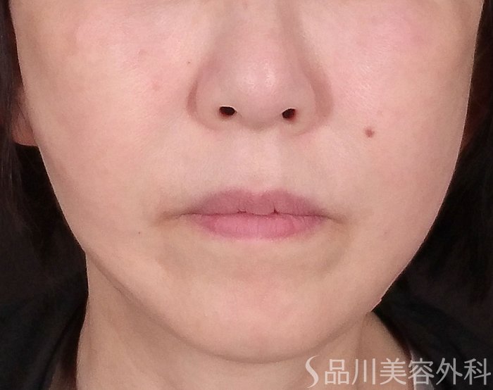 症例NO.70239のAFTER写真