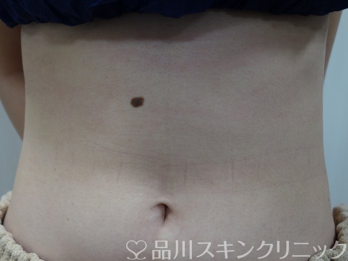 症例NO.74989のBEFORE写真