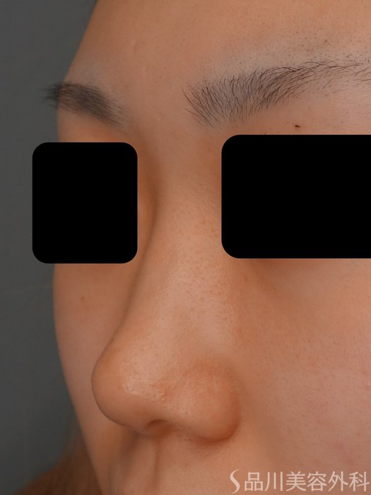 症例NO.73593のBEFORE写真