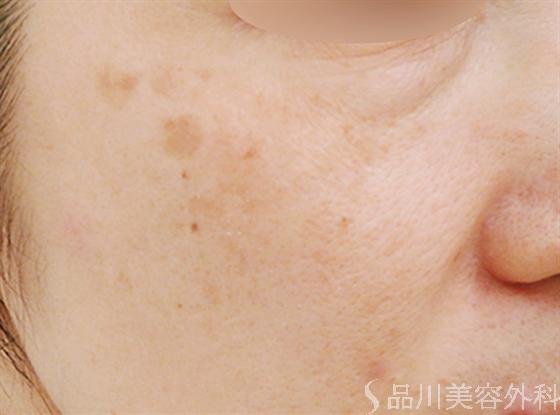 症例NO.14083のAFTER写真