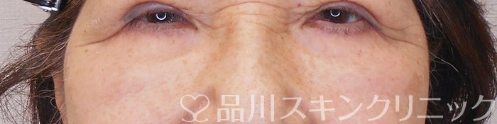 症例NO.70023のAFTER写真