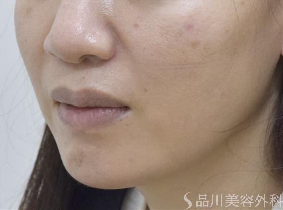 症例NO.51623のAFTER写真