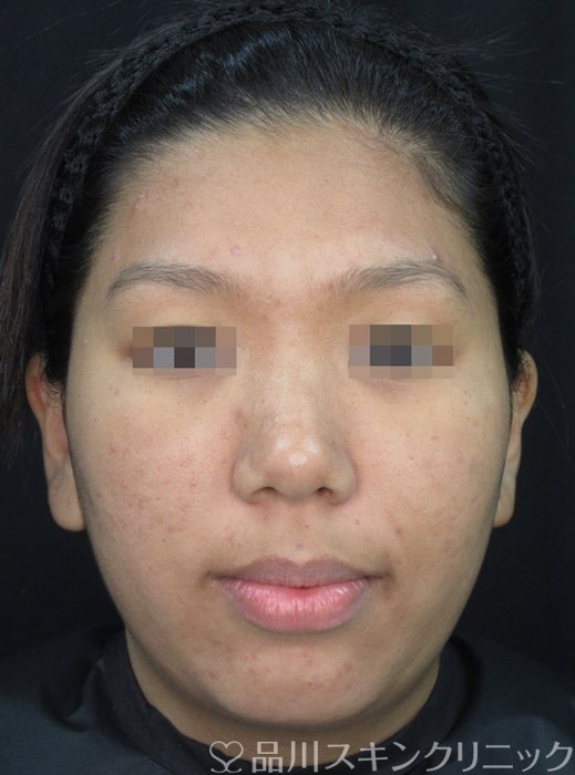 症例NO.71867のBEFORE写真