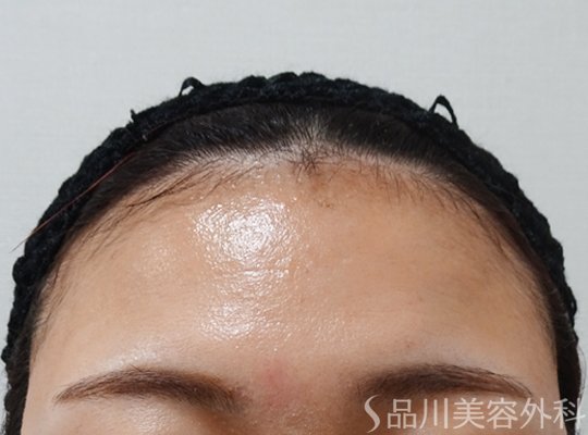 症例NO.67603のBEFORE写真