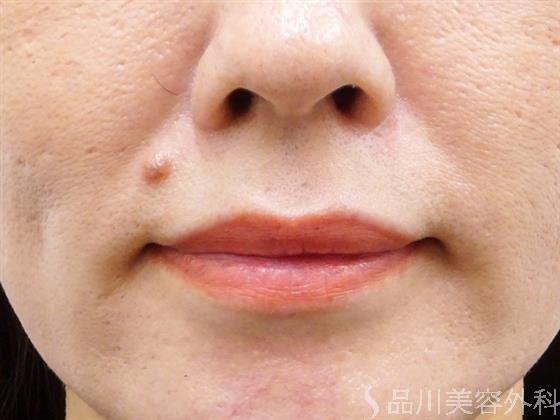 症例NO.52235のBEFORE写真