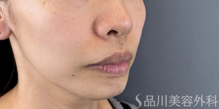 症例NO.71413のBEFORE写真