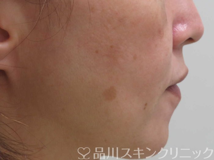 症例NO.69455のBEFORE写真