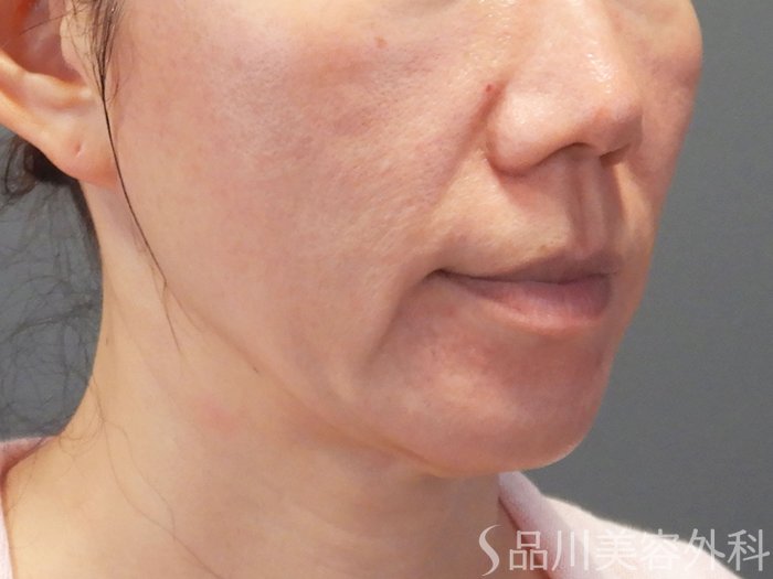 症例NO.71691のBEFORE写真