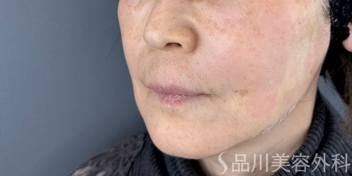 症例NO.72570のAFTER写真