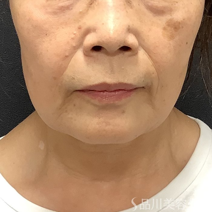 症例NO.75395のBEFORE写真