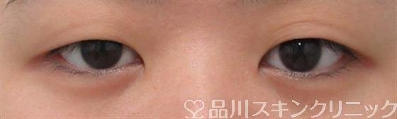 症例NO.29617のBEFORE写真