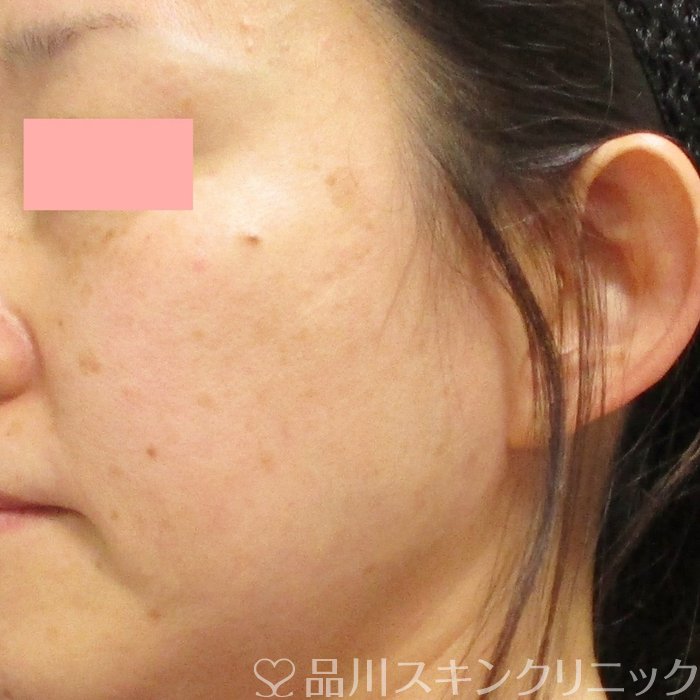 症例NO.70971のBEFORE写真