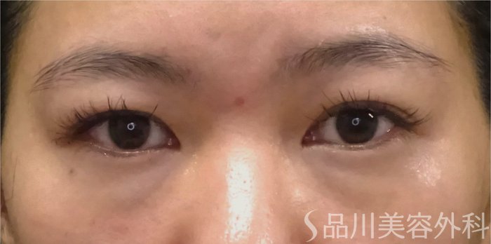 症例NO.69393のBEFORE写真