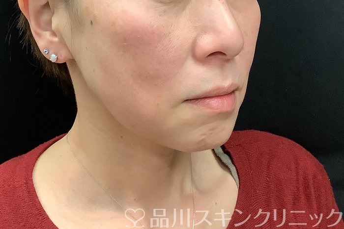 症例NO.71293のBEFORE写真