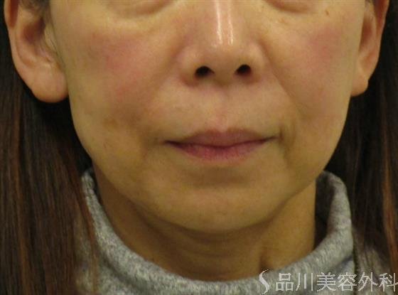 症例NO.48039のBEFORE写真