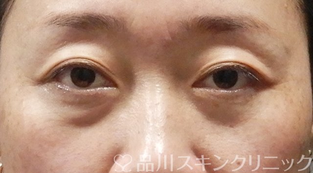 症例NO.64501のBEFORE写真