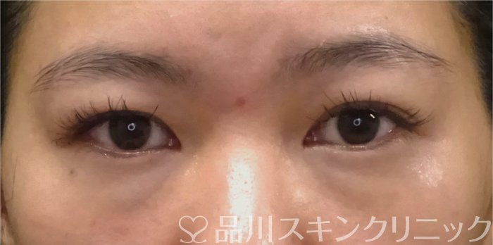 症例NO.69393のBEFORE写真