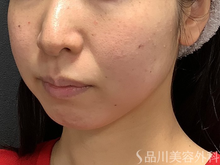 症例NO.75306のBEFORE写真