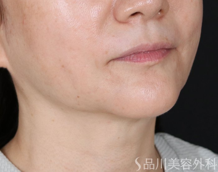 症例NO.71082のAFTER写真