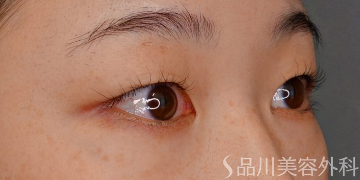 症例NO.73506のBEFORE写真