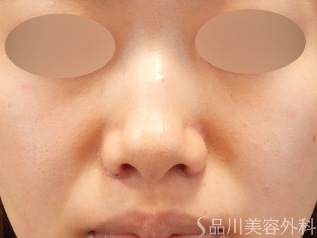 症例NO.71809のAFTER写真