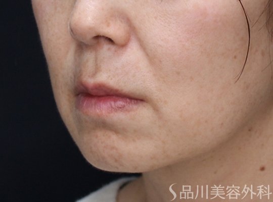 症例NO.73385のBEFORE写真