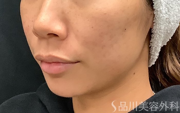 症例NO.67961のBEFORE写真