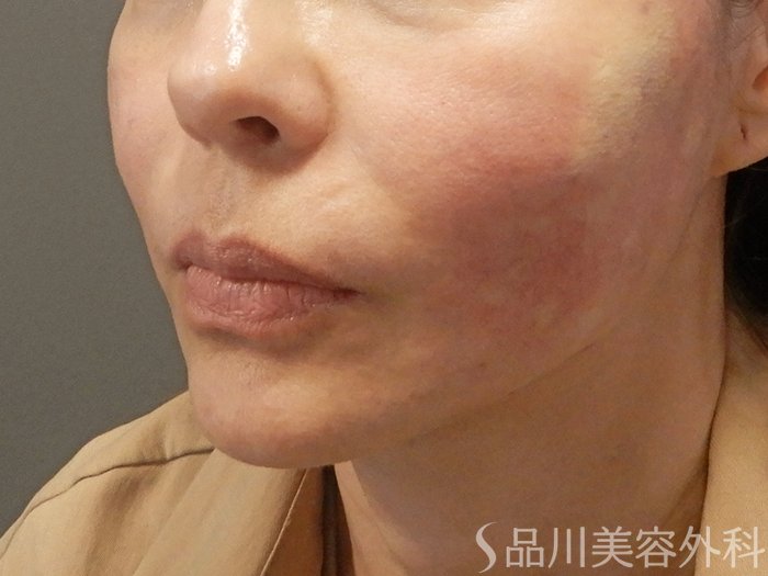 症例NO.71669のAFTER写真