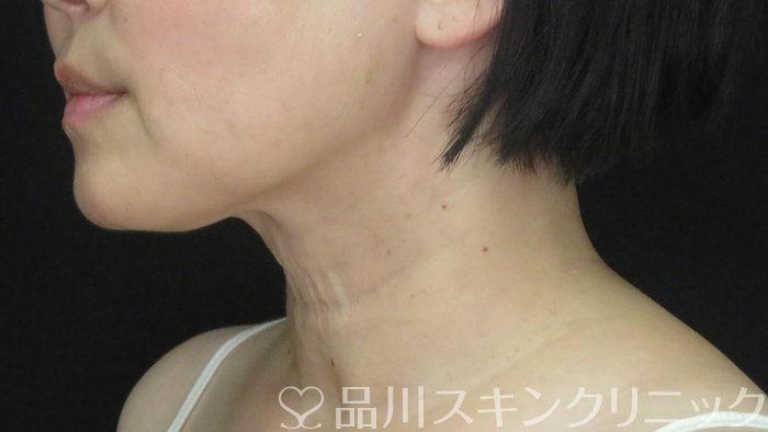 症例NO.71779のBEFORE写真