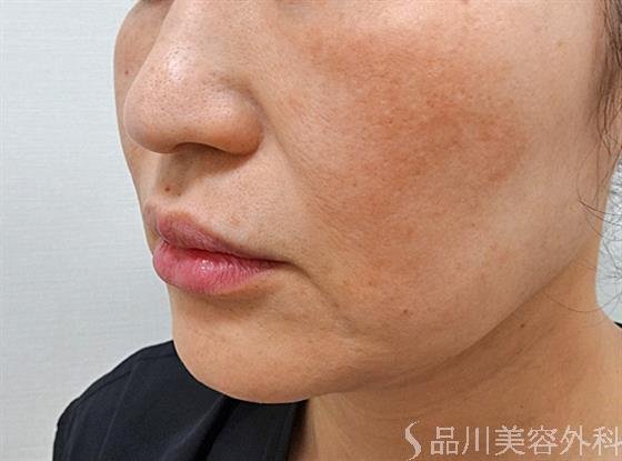 症例NO.61834のBEFORE写真