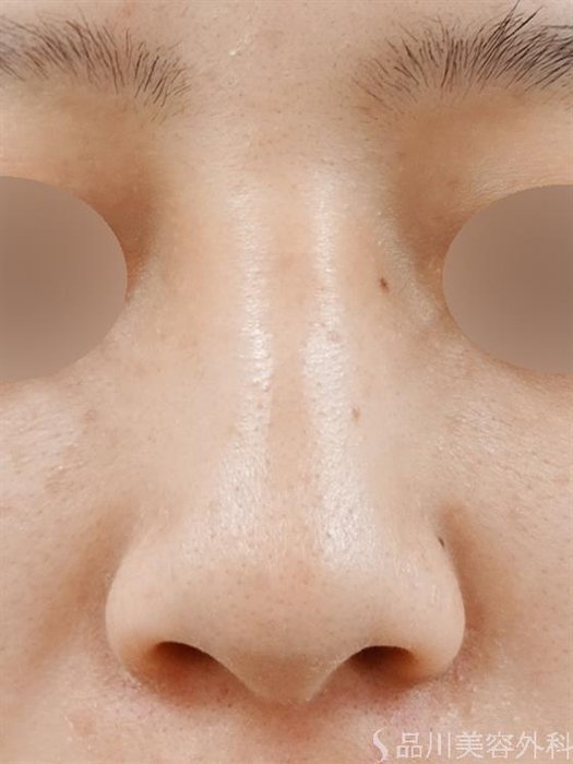 症例NO.43849のBEFORE写真