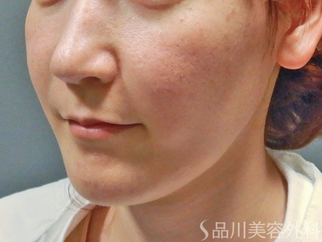 症例NO.64545のBEFORE写真
